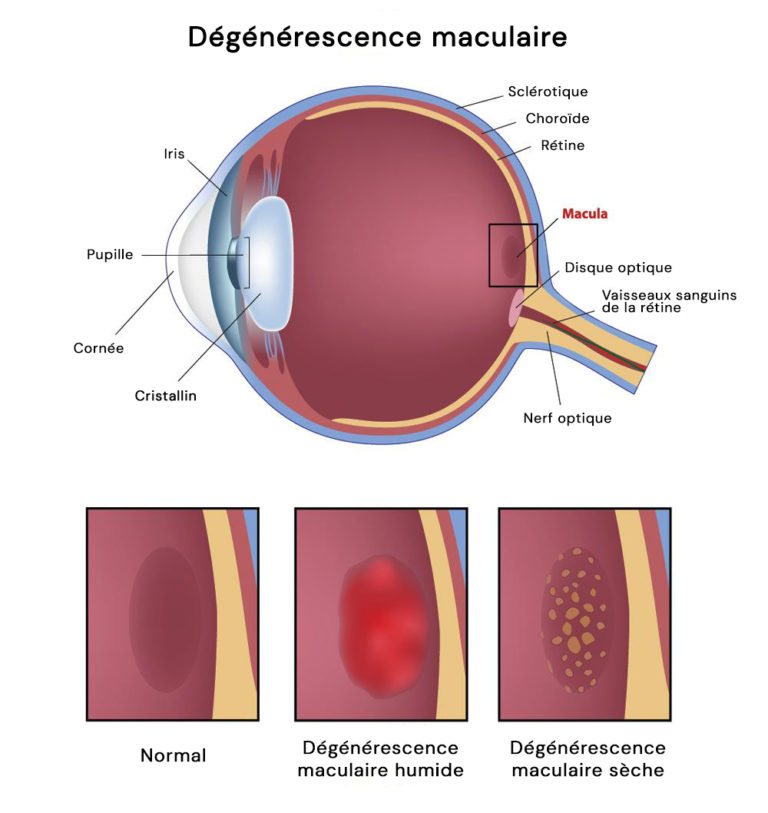 DMLA sèche ou DMLA humide ? Qu'est-ce que la dégénérescence maculaire ...